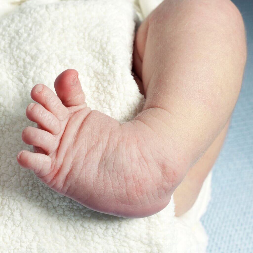  What Is Clubfoot?