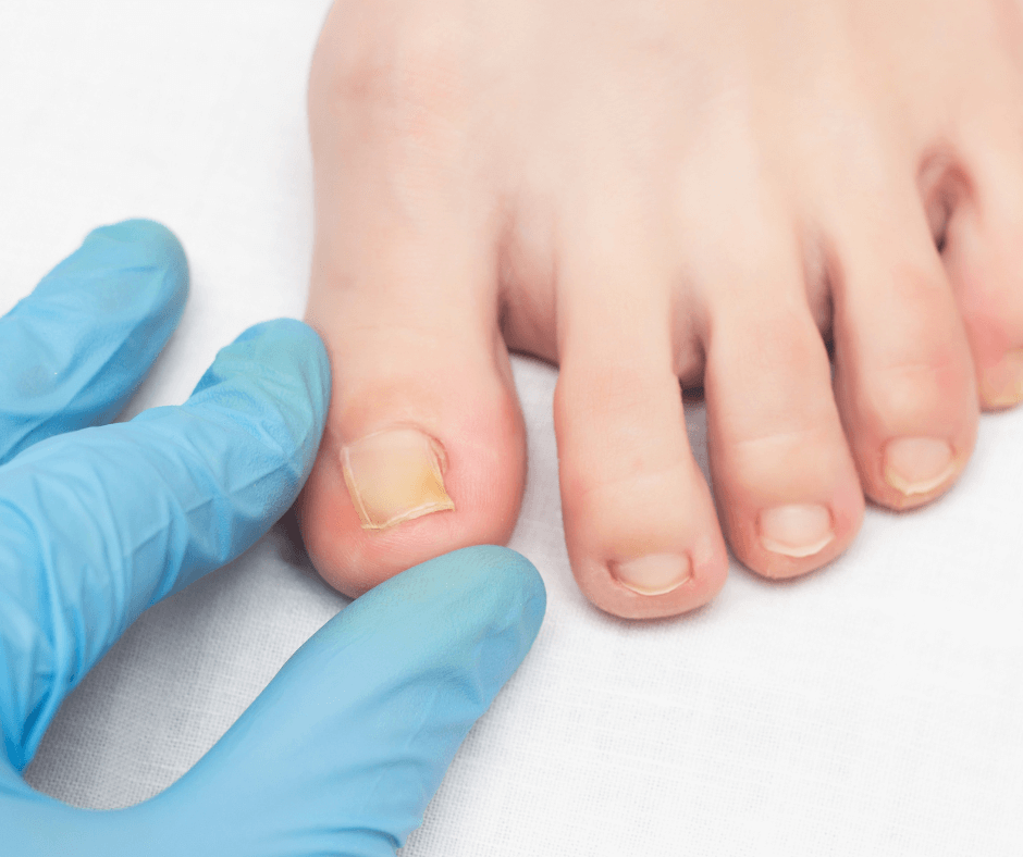 Tired of Hiding Your Feet? A New Light on Treating Toenail Fungus